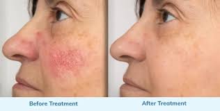 Laser Treatment for Rosacea by Progenaesthetics