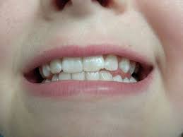 Dscn0071 Tooth Repair Chipped Tooth Repair Cosmetic Dental Work