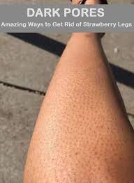 How To Get Rid Of Strawberry Legs Dark Pores On Legs Strawberry Legs Dark Pores Skin Care Acne