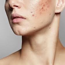 Acne Scar Treatment in Dubai | Acne Scars Removal