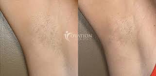 Laser hair removal uses intense thermal heat to target the melanin in the root of your hair follicles. Laser Hair Removal In Houston Tx Ovation Med Spa