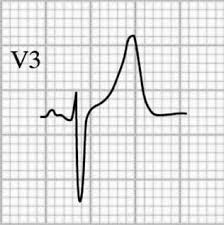 Image result for Early Repolarization