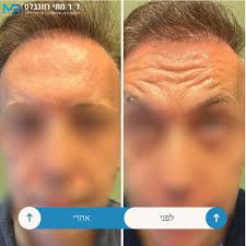 בוטוקס לא רק לנשים🫢...