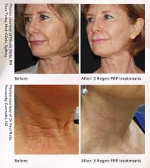 Medical Aesthetics Home Chemical Peel Plasma Facial Healthy Smoothes