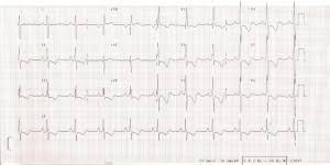 Plicní embolie, trombolýza, stratifikace rizika, hemodynamika. Informace Pro Lekare Plicni Hypertenze