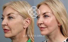 SILK Plastic Surgery