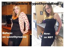 How I Lost The Weight I Gained From Hypothyroidism Hypothyroidism Symptoms Thyroid Medication Hypothyroidism