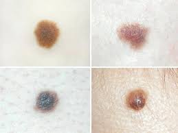 Most melanomas begin in the skin, though they can also occur in the eye. When To Worry About Moles On Your Child Different Types And Skin Cancer Risks Lifestyle News Asiaone