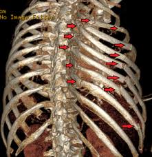 The rib cage contains intercostal muscles that allow it to move. Flail Chest Wikipedia