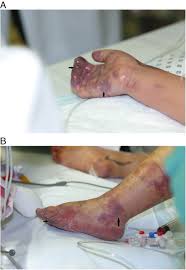 Purpura fulminans is a deadly complication of neisseria meningitidis infections due to extensive thrombosis of microvessels. Toxic Shock Syndrome Due To Group A Beta Hemolytic Streptococcus Presenting With Purpura Fulminans And Limb Ischemia In A Pediatric Patient Treated With Early Microsurgical Arteriolysis Journal Of Pediatric Surgery