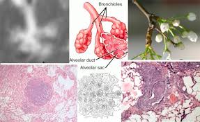 Pneumonie și dureri articulare se vindeca in saptamani. Tuberculosis As A Three Act Play A New Paradigm For The Pathogenesis Of Pulmonary Tuberculosis Sciencedirect