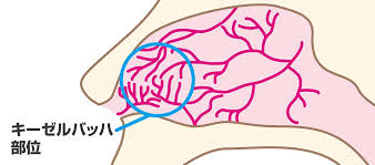 鼻血の原因と鼻血が止まらない時の止め方