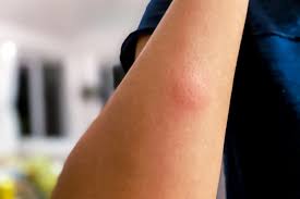Image result for mosquito bite
