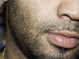 Minoxidil widens the blood vessels and opens potassium channels, sending more oxygen, blood flow and nutrients to the hair follicles. Does Rogaine Work Effectiveness For Hair Loss Beards And Women