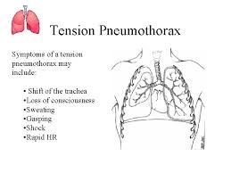 Learn what a pneumothorax is, the different types, the symptoms, how to diagnose it, and the treatment in this episode of quick & ez. Penetrating Chest Wounds Pneumothorax Tension Pneumothorax And Hemothorax