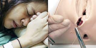 Menurut doktor, kebanyakan kes jahitan terbuka adalah disebabkan berlaku jangkitan kuman pada luka bersalin. Jahitan Bersalin Terbuka Ini Simptom Yang Anda Perlu Peka