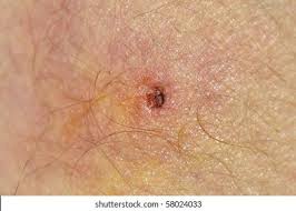 Image result for infected tick bite