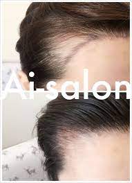 发际线填补 ai salon 英国伦敦最专业的韩式半永久机构服务项目 纹眉 孕睫术 眼线 美瞳线 纹唇 发际线 更多效果图关注 微信号liby0996 beauty clinic beauty pearl earrings