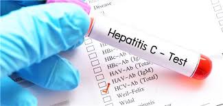 But it causes few symptoms. Hepatitis C Welche Patienten Von Einem Screening Besonders Profitieren Konnten