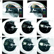 In some cases, advanced lung cancer can spread to the brain, causing secondary brain cancer. Local Control And Recurrence Of Stage I Non Small Cell Lung Cancer After Carbon Ion Radiotherapy Radiotherapy And Oncology