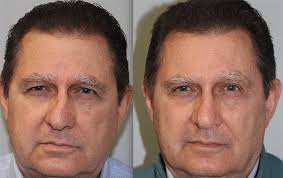 Maybe you would like to learn more about one of these? What S The Difference Between Rhinoplasty And Septoplasty