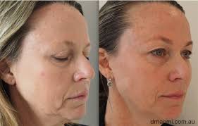 Can jowls can be improved without surgery? Jowls And Sag Injecting Dermal Filler To Improve The Lower Face Best Clinic Sydney For Dermal Fillers
