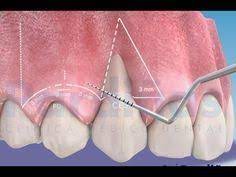 Pin By Vero Daley On Anatomia Dental Dentistry Dental Periodontitis