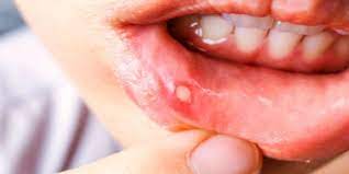 Bagi pilihan rawatan lain sebagai cara menghilangkan ulser, anda mungkin boleh menggunakan susu magnesia pada luka lepuh atau membilasnya dengan air garam. Cara Hilangkan Ulser Dalam Mulut Bayi Kanak Kanak Dewasa Theasianparent Malaysia