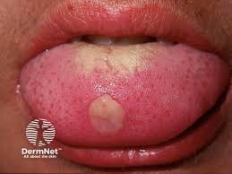 Image result for syphilis ulcer