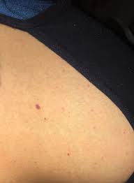If you get a cut or a bite on your breast. What Does The Inflammatory Breast Cancer Rash Look Like