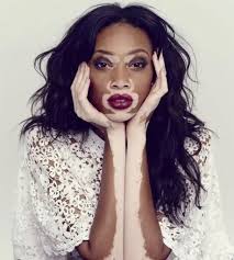 Image result for vitiligo model