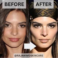 ONLY BOTOX? Only admitting to Botox? What do you think? Brow lift? Cheek  filler or implants? Buccal Fat removal? Lip filler !!! Emily Ratajkowski:  THEN AND NOW ✨ She's stunning, but is