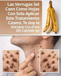 Las Verrugas Se Caen Como Hojas Con Solo Aplicar Este Tratamiento Casero.  Te doy la receta. Cambio de un simple OK 👇🏻 Receta en el primer comentario