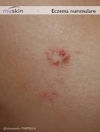 Image result for Eczema nummulare