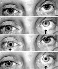 Image result for Pupillary Paralysis