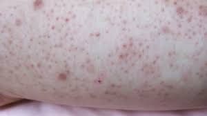 May 28, 2021 · get to know keratosis pilaris. 10 Facts About Keratosis Pilaris From Dr Pimple Popper Mental Floss