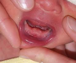 Image result for Neonatal Teeth