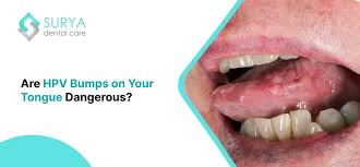 Image result for papillomavirus tongue)