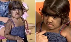 Hagberg b., aicordi j., dias k., ramos o. Little Girl With Werewolf Syndrome Stops Receiving Treatment Because Device Breaks World News Express Co Uk