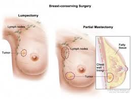 Some people do not have any signs or symptoms at all. Options For Women With Brca Gene Mutations Who Are Considering Breast Reconstruction Surgery Fox Chase Cancer Center Philadelphia Pa