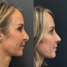 𝑹𝒆𝒗𝒊𝒔𝒊𝒐𝒏 𝑹𝒉𝒊𝒏𝒐𝒑𝒍𝒂𝒔𝒕𝒚 This amazing patient had a  rhinoplasty over 20 years ago and had subsequent trauma to the nose leaving  her with uneven nasal bones plus weakened and warped cartilage with