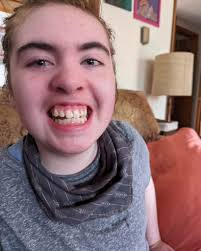 My question is: when you started taking Daybue with the small starting  dose, after 14 days you end up using only part of the bottle. What do you  do with the remainder?