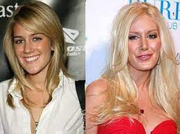 A hernia occurs when there is weakness or even a whole in a muscle that allows tissue or organs to bulge up through the defect. Celebrity Plastic Surgery Before After