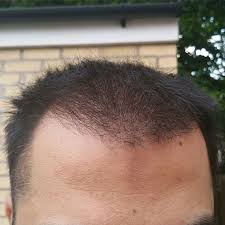 Some clinics even use machines that give you unmatched accuracy and a natural hairline. Uk Hair Transplant Repair Patient Hasson Wong