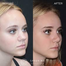 I'm so thrilled for this sweet patient who wanted to make some small  changes to her nose to feel more confident. She had a great profile, but  wanted to refine the width