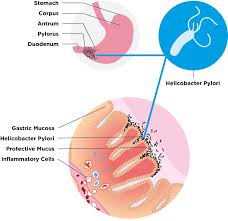 Look out for signs of cachexia (decrease in muscle mass). Helicobacter Pylori Guts Uk