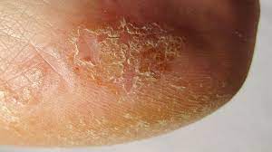 Namun, pada kasus psoriasis, terjadi produksi kulit hanya terjadi dalam 3 sampai 4 hari saja. Sederet Penyakit Ini Bisa Jadi Penyebab Kulit Kering Bersisik Bukan Cuma Soal Cuaca