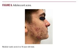 The Many Faces of Pediatric Acne: A Practical Algorithm for Treatment,  Maintenance Therapy, and Skincare Recommendations for Pediatric Acne  Patients