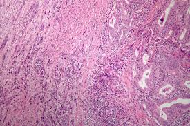 What are the signs and symptoms of thyroid cancer? Anaplastic Thyroid Cancer Wikipedia