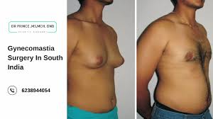 Image result for Gynecomastia